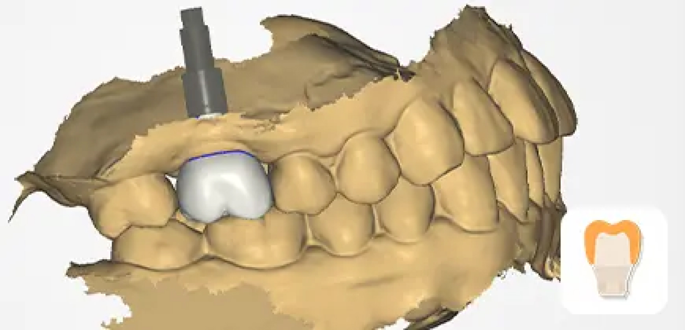 UPCAD implant